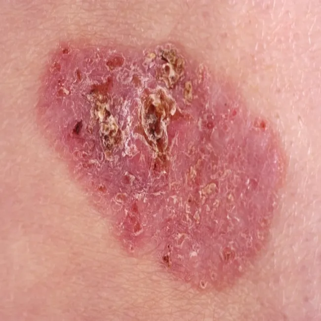 basal cell carcinoma