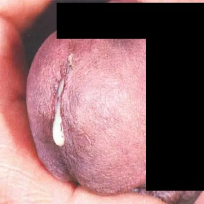 biała wydzielina z cewki moczowej u mężczyzn