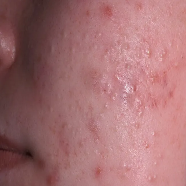 białe grudki na policzkach zaskórniki zamknięte