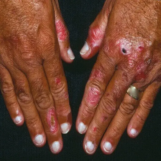 Białe paznokcie matowe choroba