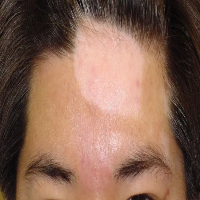 białe plamy na czole