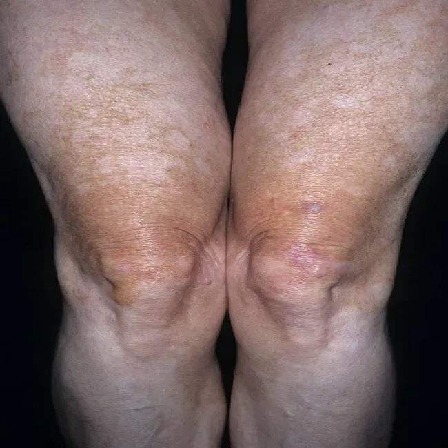 białe plamy na nogach