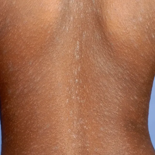 blaszka macierzysta łupież różowy Giberta