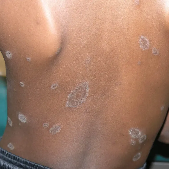 blaszka macierzysta łupież różowy