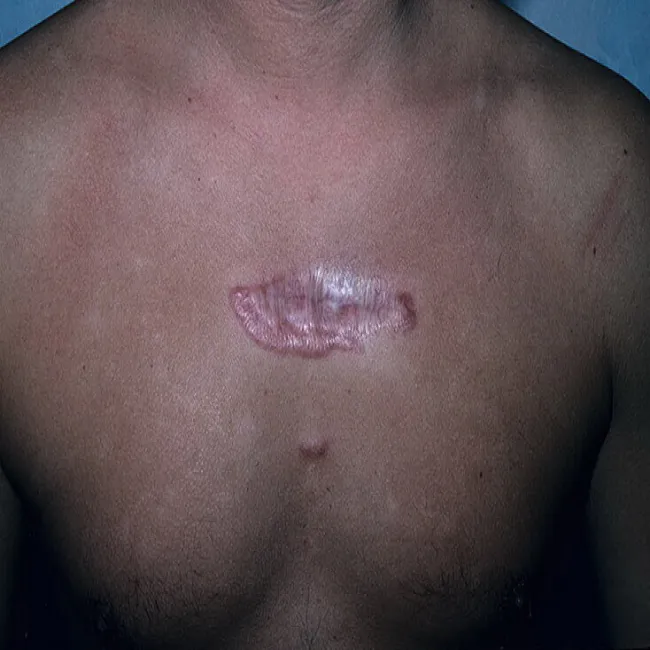 bliznowce na klatce piersiowej