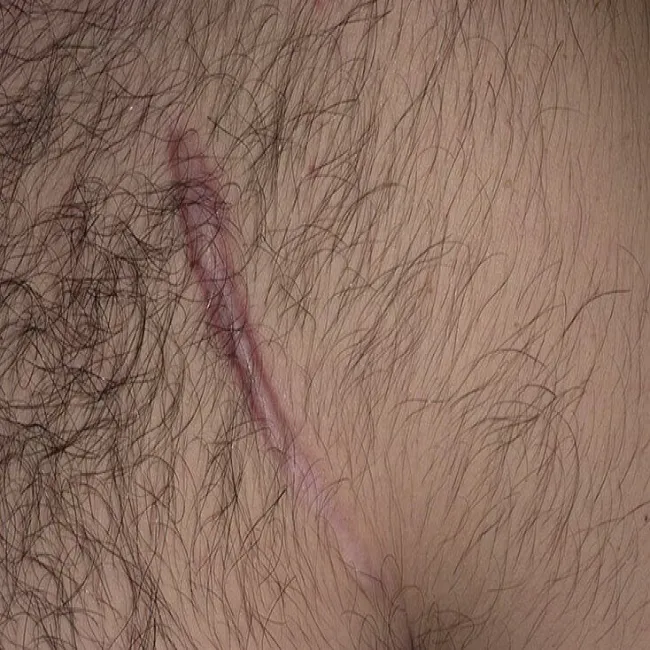 bliznowiec samoistny