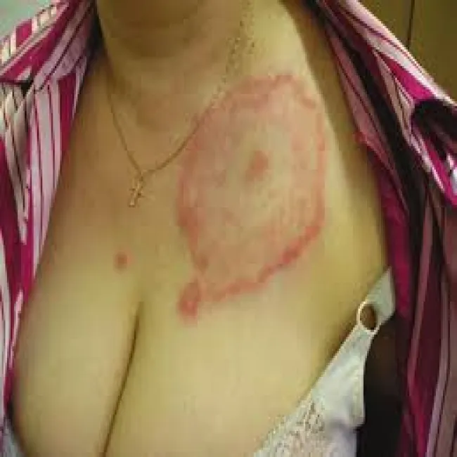 borelioza objawy skórne  