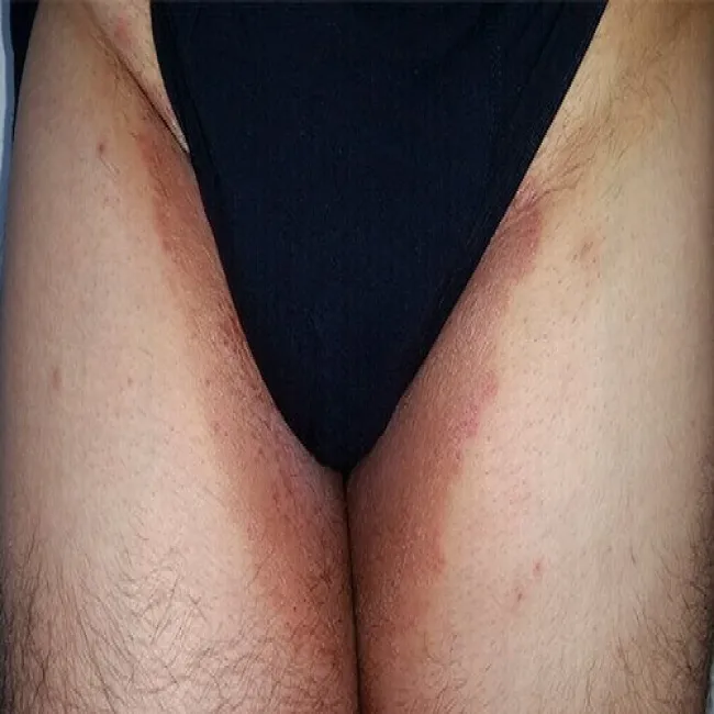 brązowe plamy w pachwinach