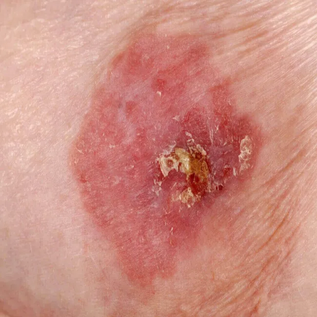 brodawka łuszcząca