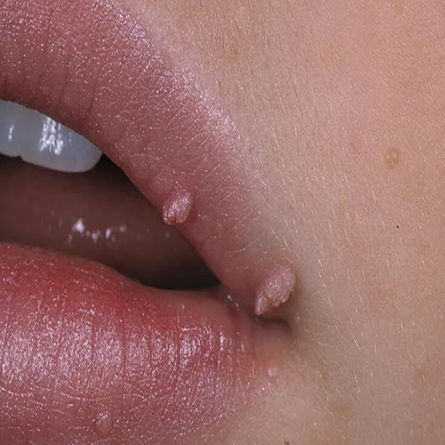 brodawka na ustach