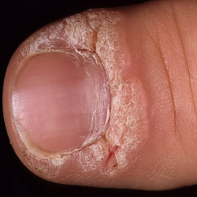 brodawka na wale paznokciowym