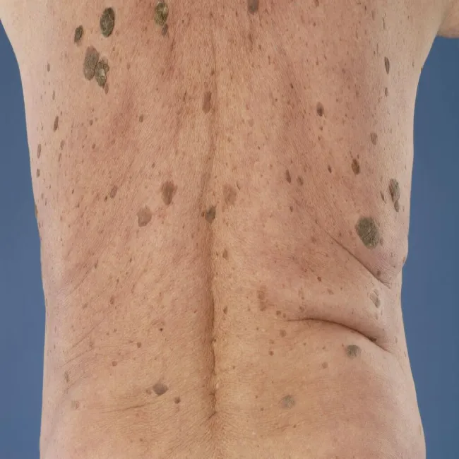 brodawki łojotokowe na plecach