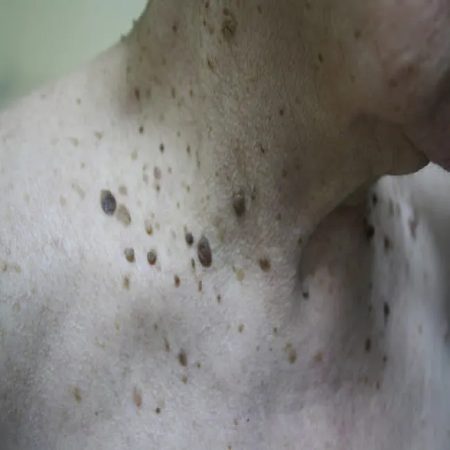 brodawki łojotokowe na szyi