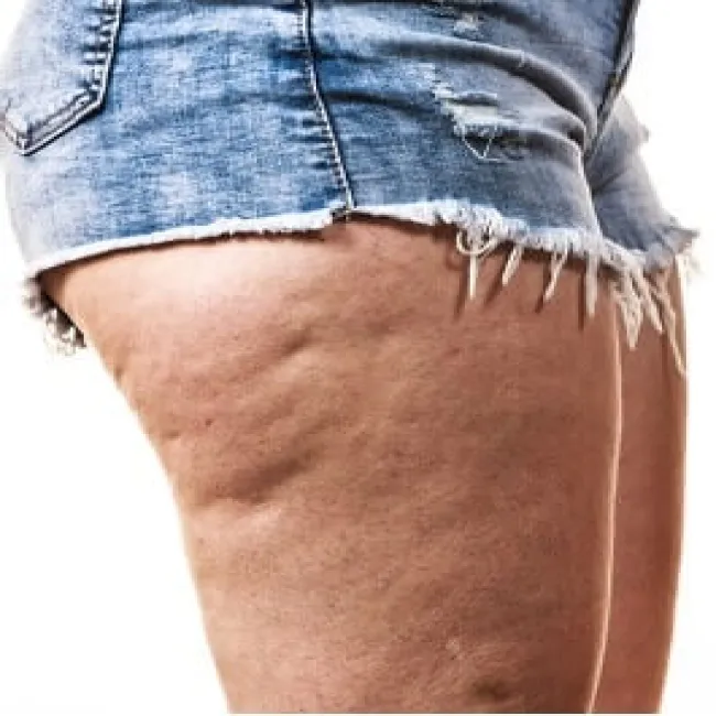 cellulit tłuszczowy