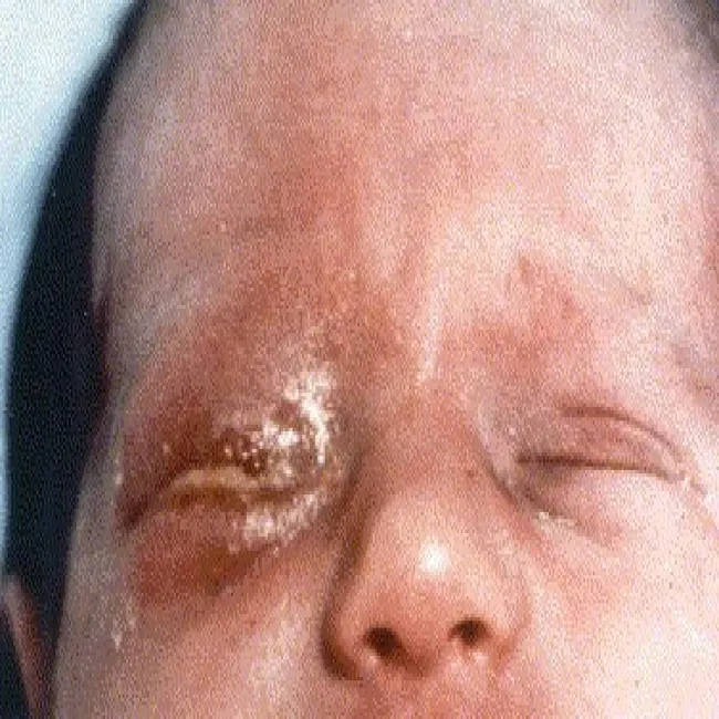 chlamydia u niemowlaka