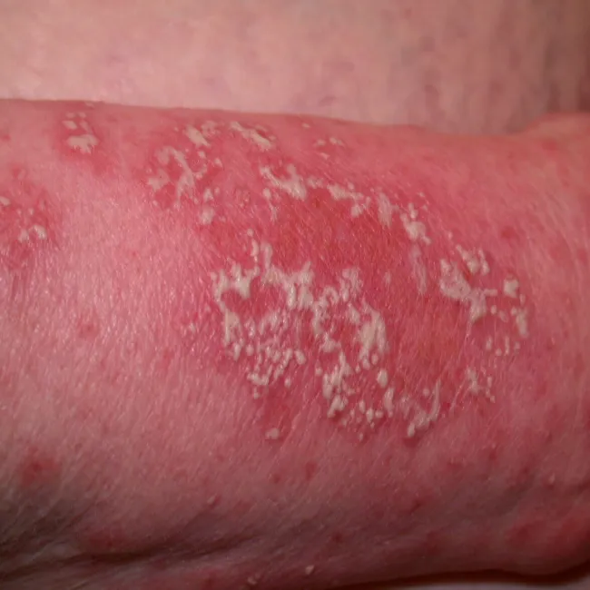 choroba Sneddona i Wilkinsona