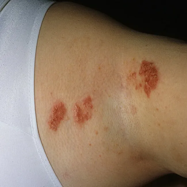 Choroba Haileya-Haileya