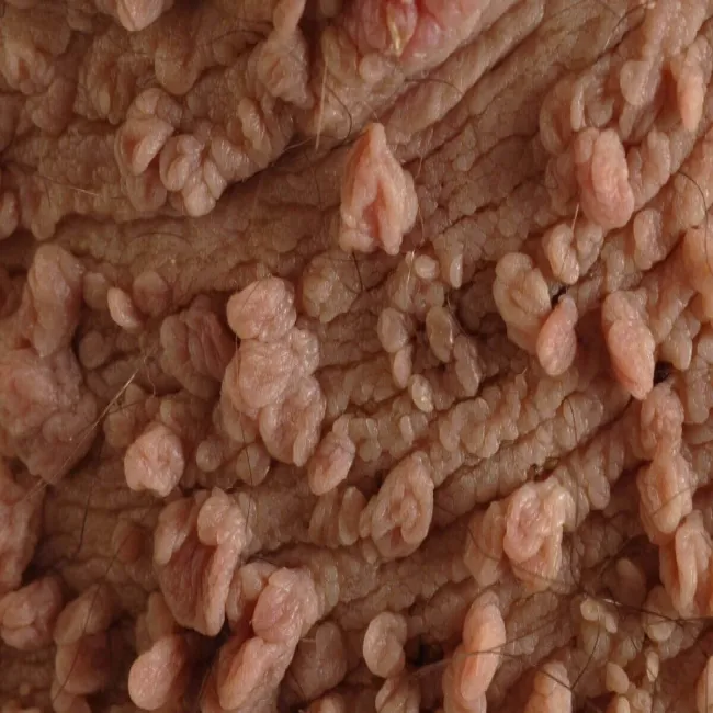 choroba skóry włókniaki