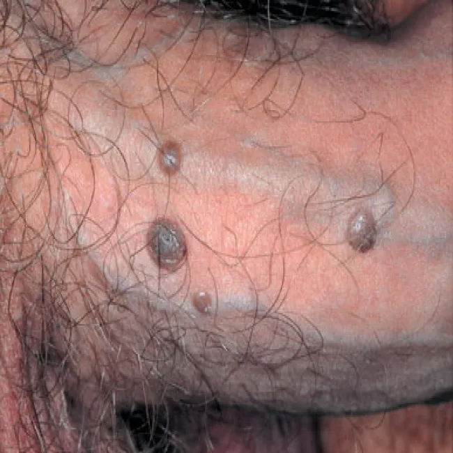 choroby penisa grudkowatość bowenoidalna 