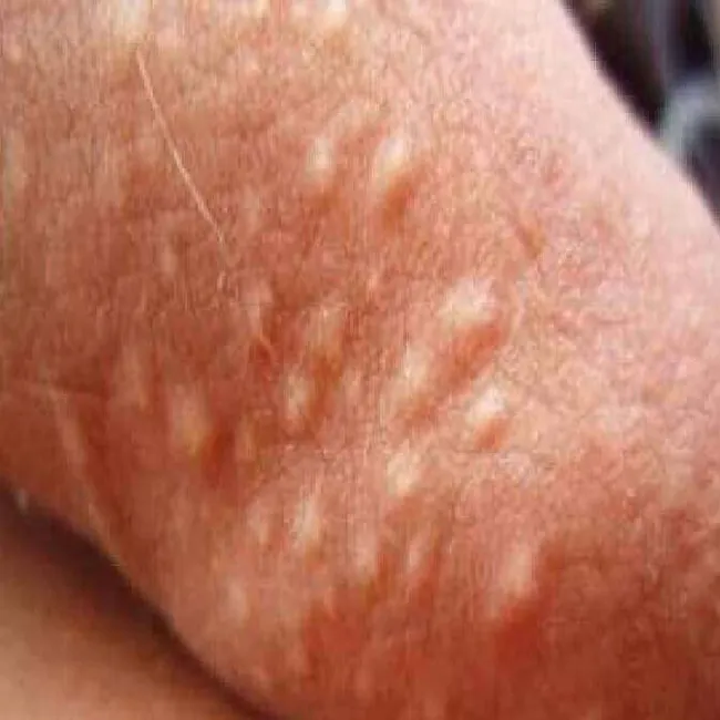 choroby prącia obrazy zapalenie mieszków włosowych