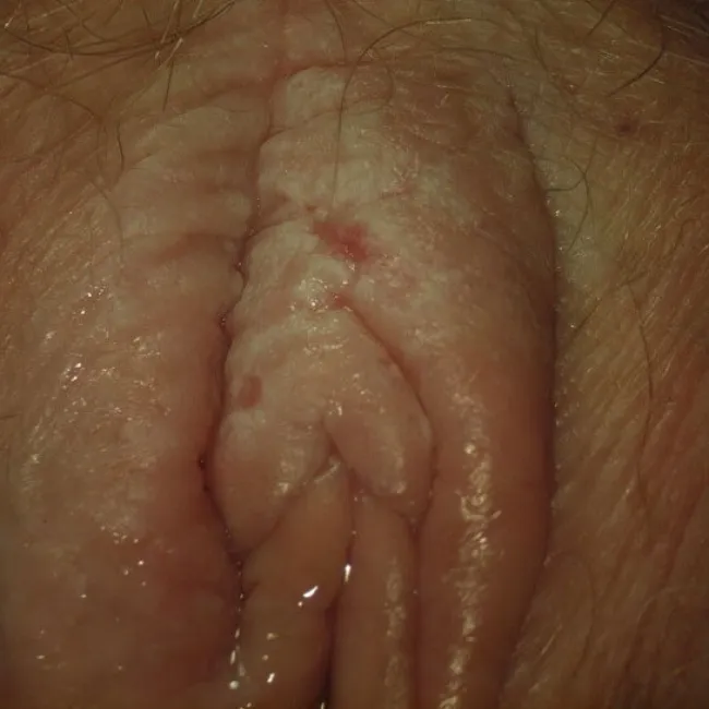 choroby sromu leukoplakia sromu