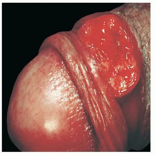 choroby weneryczne u mężczyzn ziarniniak pachwinowy 