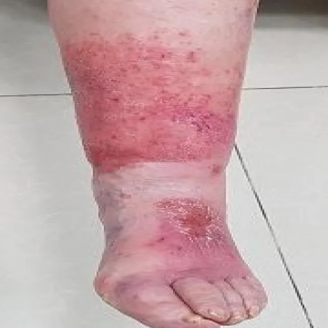 ciemnoczerwona skóra na nodze choroba róża