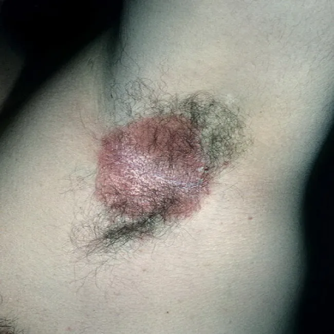 czerwone plamy pod pachami odparzenia