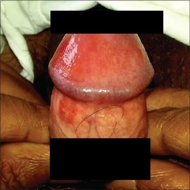 czerwone swędzące plamy na członku zapalenie żołędzi Zoon 