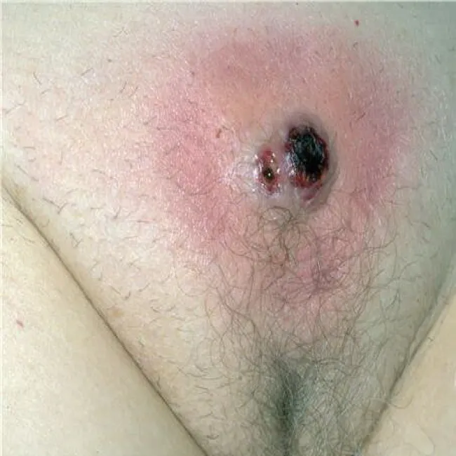 czyrak miejsc intymnych