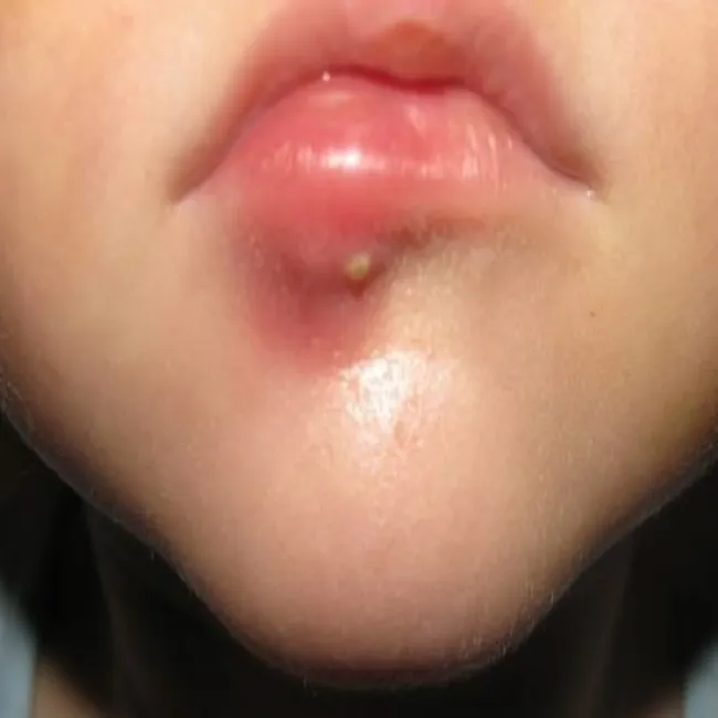 czyrak na twarzy zdjęcia