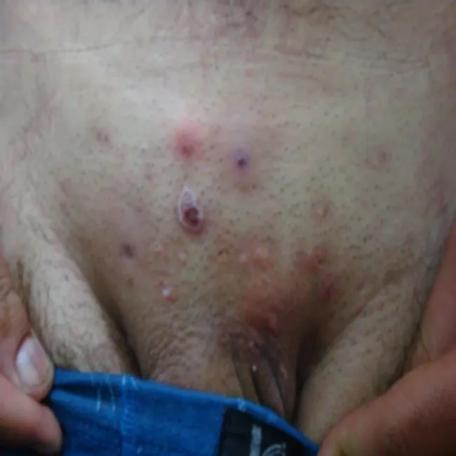 czyrak miejsce intymne