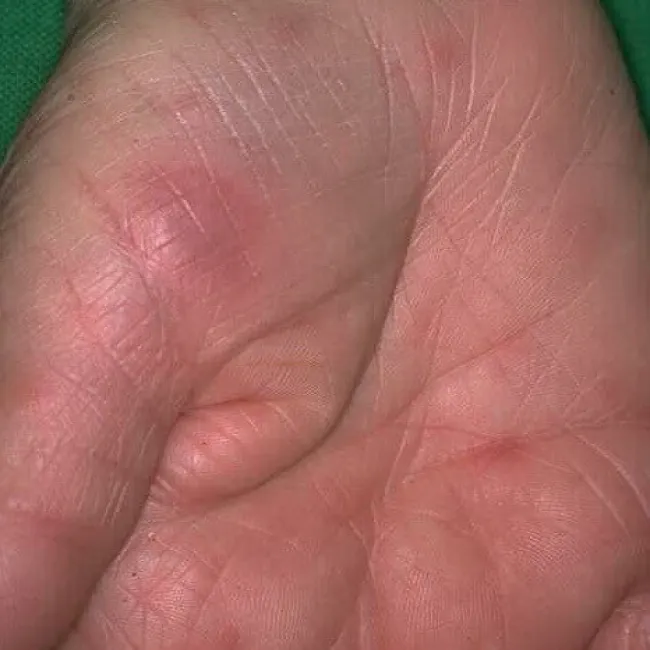 dermatosis neutrophilica febrilis acuta