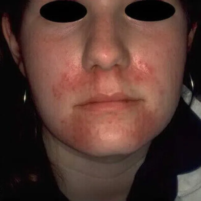 dermatoza okołoustna w ciąży