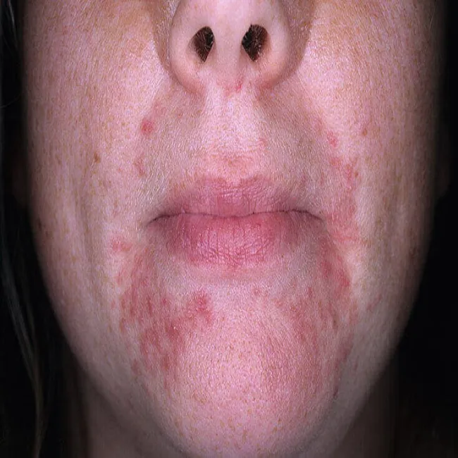dermatoza okołoustna