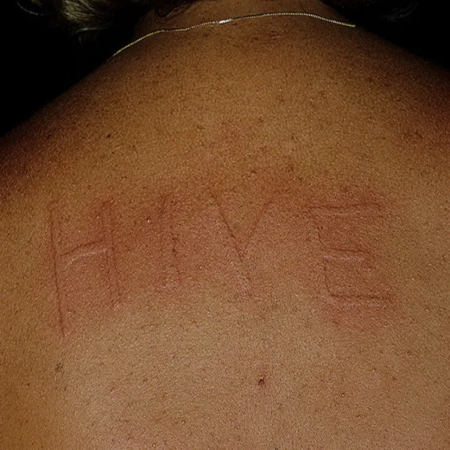 dermografizm napis na skórze