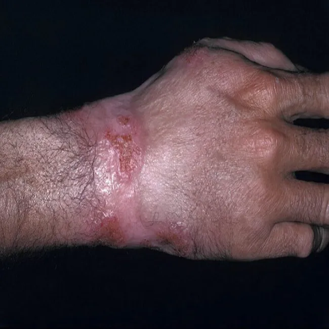 drożdżyca amerykańska 