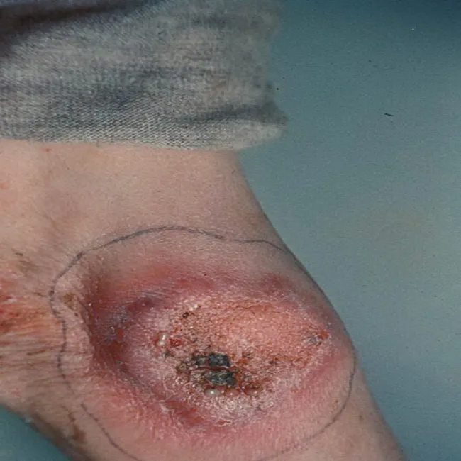 drożdżyca północnoamerykańska