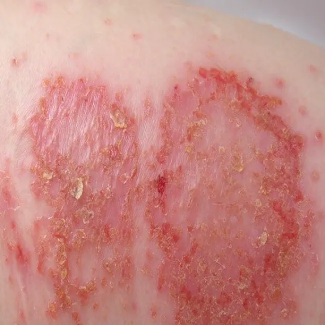 eczema nummulare