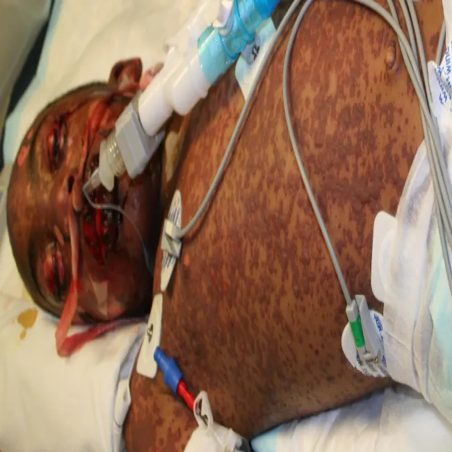 erythema multiforme major