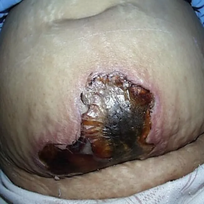 gangrena zmiany skórne