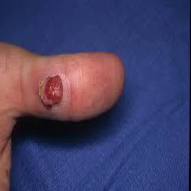 granuloma gravidarium