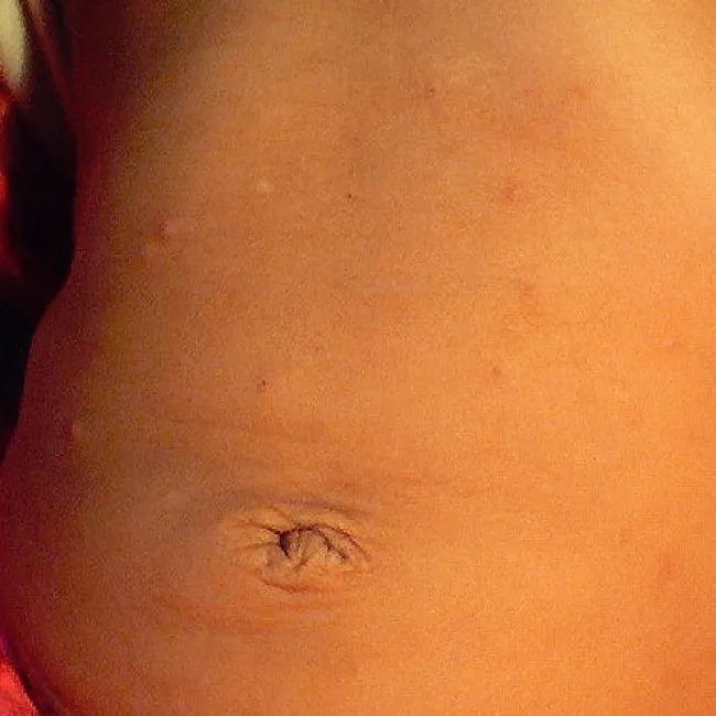 grudki na skórze u dziecka świerzb