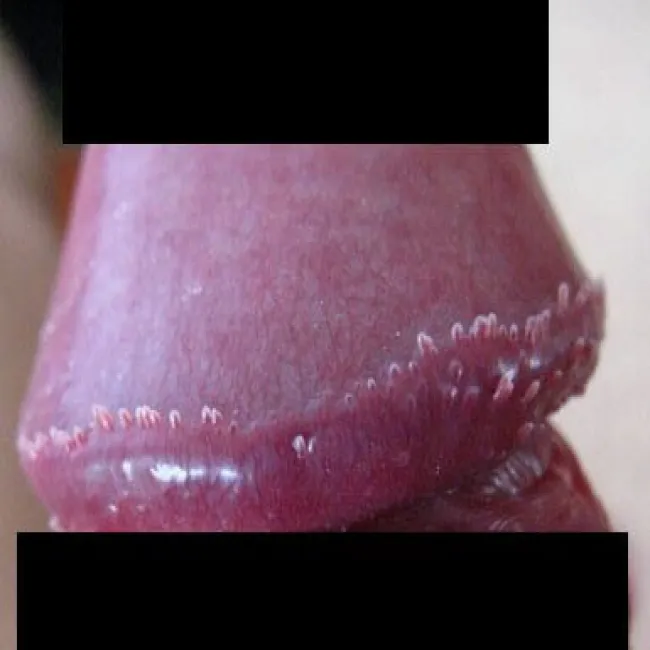 grudki perliste na żołędziu