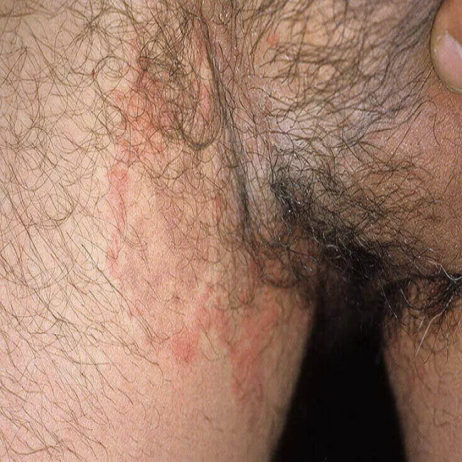 grzybica pachwin u mężczyzn