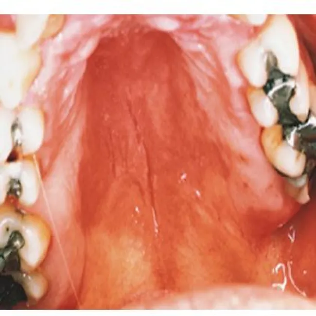 grzybica podniebienia