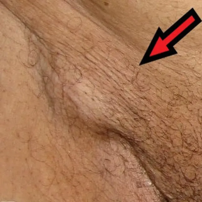 guz w okolicach pachwiny