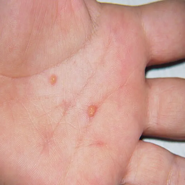 guzki na dłoniach żółtakoziarniniakowatość młodzieńcza 