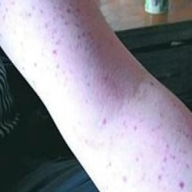 idiopathic thrombocytopenia