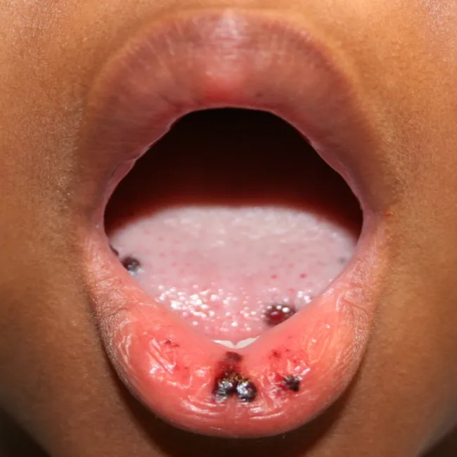 immunologiczna plamica małopłytkowa